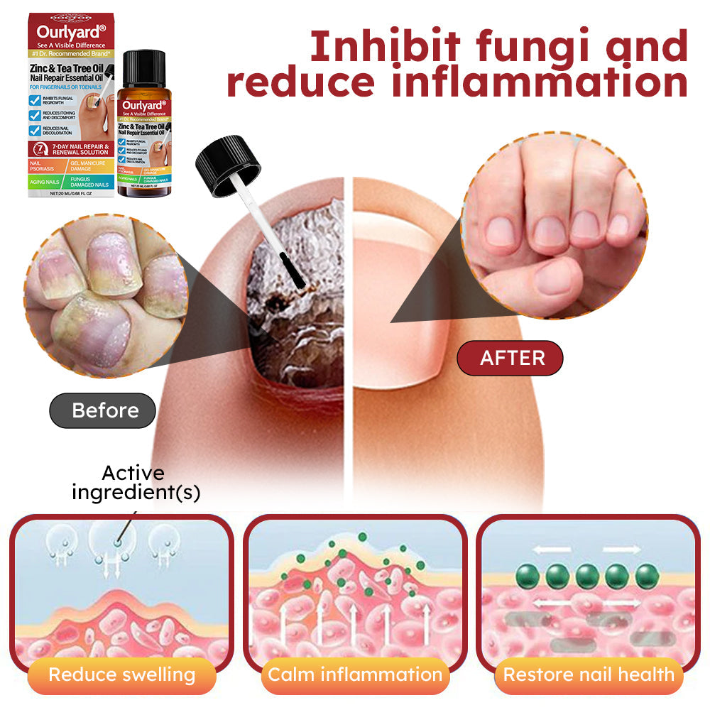✅ Made and Shipped from USA | Ourlyard® Zinc & Tea Tree Oil Nail Repair Essential Oil (Comprehensive repair, powerful treatment for all nail disorders)
