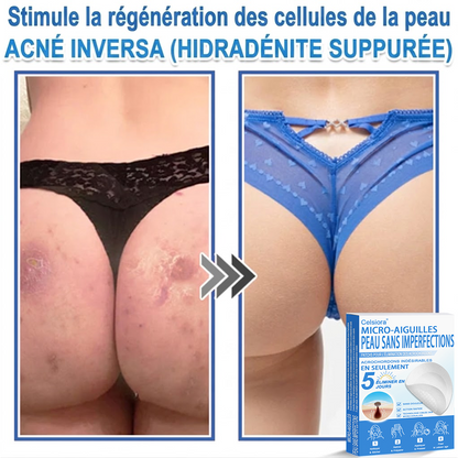🌿Pansements hydrocolloïdes à micro-aiguilles Celsiora® 2-en-1