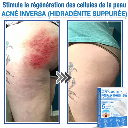 🌿Pansements hydrocolloïdes à micro-aiguilles Celsiora® 2-en-1