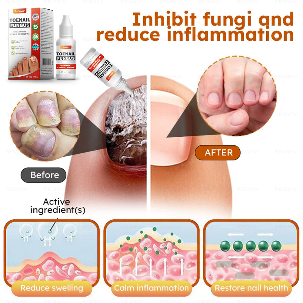 ✅ Made and Shipped from USA | Zvoevo® Toenail Fungus Treatment Extra Strength, Antifungal Solution for Toenail or Fingernail, Triple Action Formula for Remove Fungal, Repair and Renewal Damaged Nails🐞