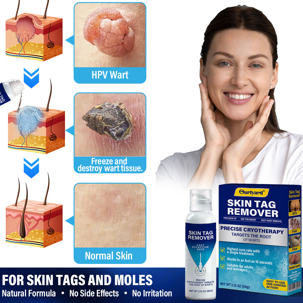 ✅Official Store |Ourlyard® TagRecede Cryo Treatment Spray  | Removes warts and skin tags, suitable for all skin types 💘💘