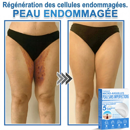 🌿Pansements hydrocolloïdes à micro-aiguilles Celsiora® 2-en-1