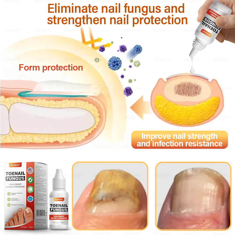 ✅ Made and Shipped from USA | Zvoevo® Toenail Fungus Treatment Extra Strength, Antifungal Solution for Toenail or Fingernail, Triple Action Formula for Remove Fungal, Repair and Renewal Damaged Nails🐞