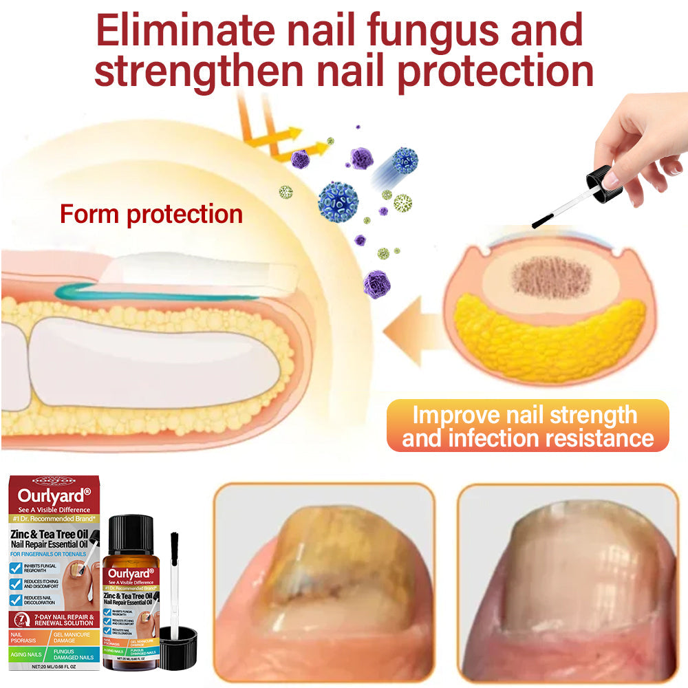 ✅ Made and Shipped from USA | Ourlyard® Zinc & Tea Tree Oil Nail Repair Essential Oil (Comprehensive repair, powerful treatment for all nail disorders)
