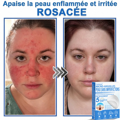🌿Pansements hydrocolloïdes à micro-aiguilles Celsiora® 2-en-1