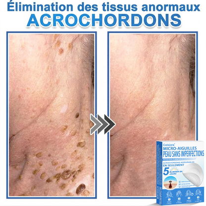 🌿Pansements hydrocolloïdes à micro-aiguilles Celsiora® 2-en-1