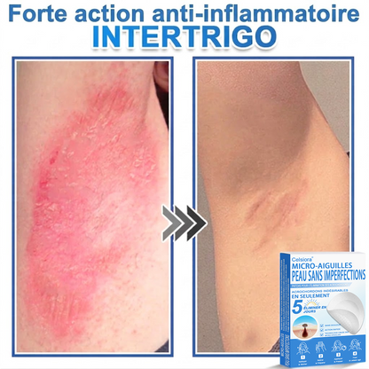 🌿Pansements hydrocolloïdes à micro-aiguilles Celsiora® 2-en-1